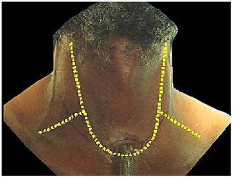 1.12: Laryngectomy .
